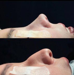 Before and after open rhinoplasty results at Renaissance Clinic, improved nose profile