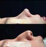 Before and after open rhinoplasty results at Renaissance Clinic, improved nose profile