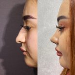 Before and after open rhinoplasty result at Renaissance Clinic, improved nose profile