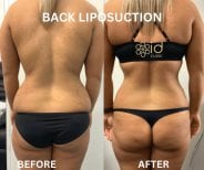 Efekty liposukcji pleców przed i po w ID Clinic Bangkok, widoczna poprawa konturu ciała