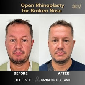 Vorher-nachher-Ergebnis offene Rhinoplastik bei Nasenbruch in ID Clinic Bangkok