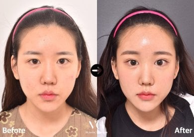 Before and after threads lifting result at VG Plastic Surgery – visible facial contour improvement