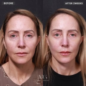 Before and after threads lifting at VG Plastic Surgery, visible facial rejuvenation result