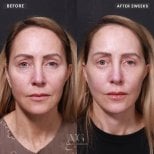 Before and after threads lifting at VG Plastic Surgery, visible facial rejuvenation result
