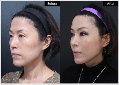 Before and after threads lifting results at VG Plastic Surgery – visible facial rejuvenation