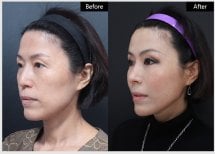 Before and after threads lifting results at VG Plastic Surgery – visible facial rejuvenation