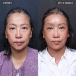 Before and after threads lifting at VG Plastic Surgery, visible facial rejuvenation result
