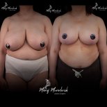 Before and after breast reduction results at Renaissance Clinic, improved breast shape and size