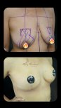 Before and after breast augmentation at Renaissance Clinic, visible lift and contour result