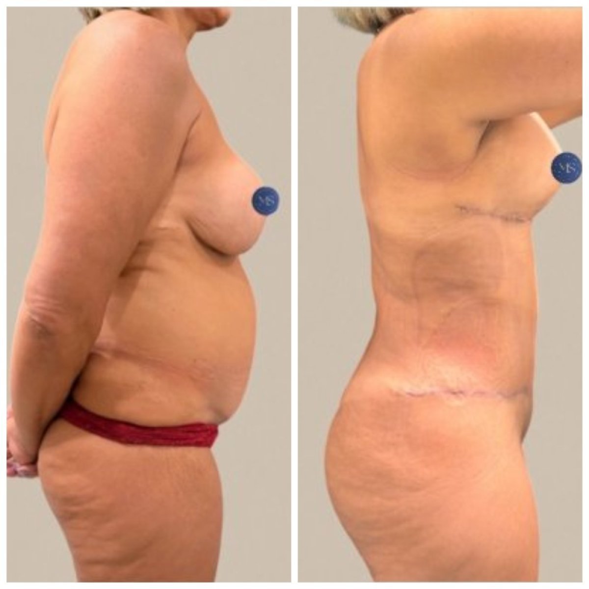 Resultados antes y después de mommy makeover en Dr. Michel Salameh - Plastic And Aesthetic Surgery