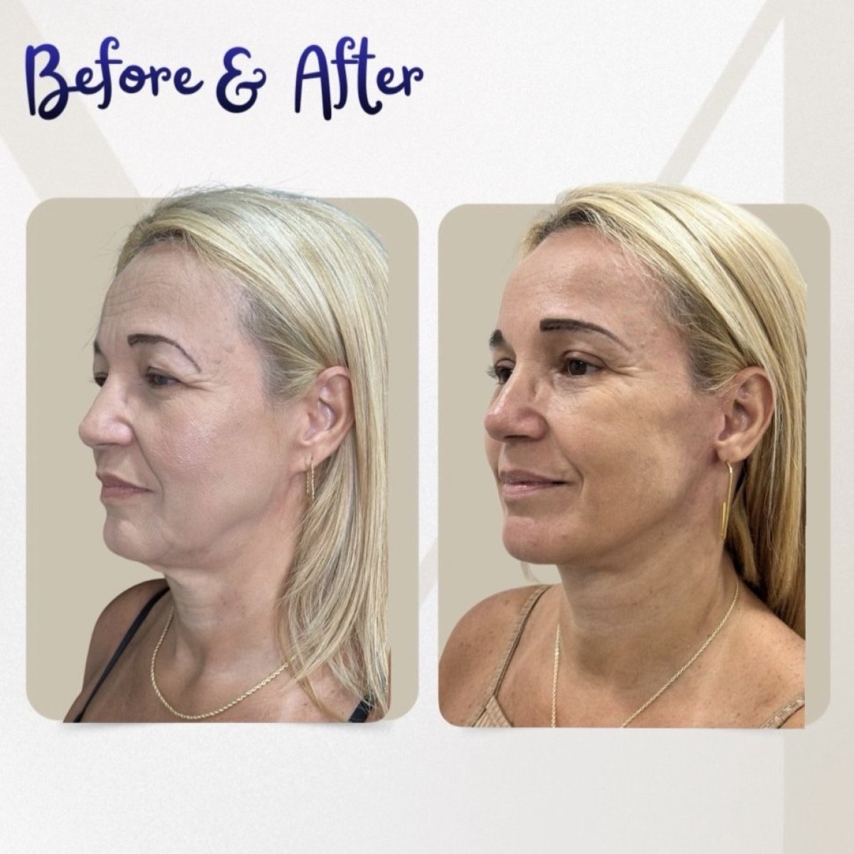 Resultados de lifting de cuello antes y después en Dr. Michel Salameh - Plastic And Aesthetic Surgery