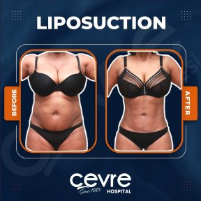 Before and after abdominal liposuction results at Adem and Havva Medical Center, body contouring