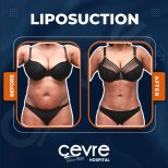 Before and after abdominal liposuction results at Adem and Havva Medical Center, body contouring