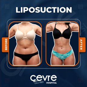 Before and after abdominal liposuction results at Adem and Havva Medical Center, body contouring
