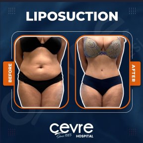 Before and after abdominal liposuction results at Adem and Havva Medical Center, slimmer waist