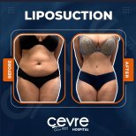 Before and after abdominal liposuction results at Adem and Havva Medical Center, slimmer waist
