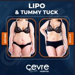 Before and after abdominal liposuction results at Adem and Havva Medical Center, slimmer waist