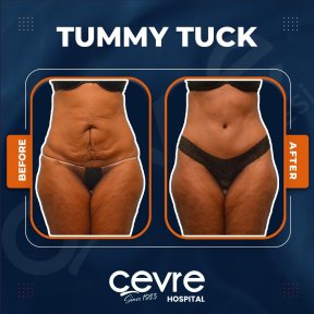 Before and after tummy tuck results at Adem and Havva Medical Center, visible flatter abdomen