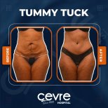 Before and after tummy tuck results at Adem and Havva Medical Center, visible flatter abdomen