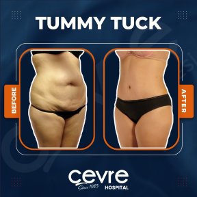 Before and after abdominal liposuction results at Adem and Havva Medical Center, flatter tummy