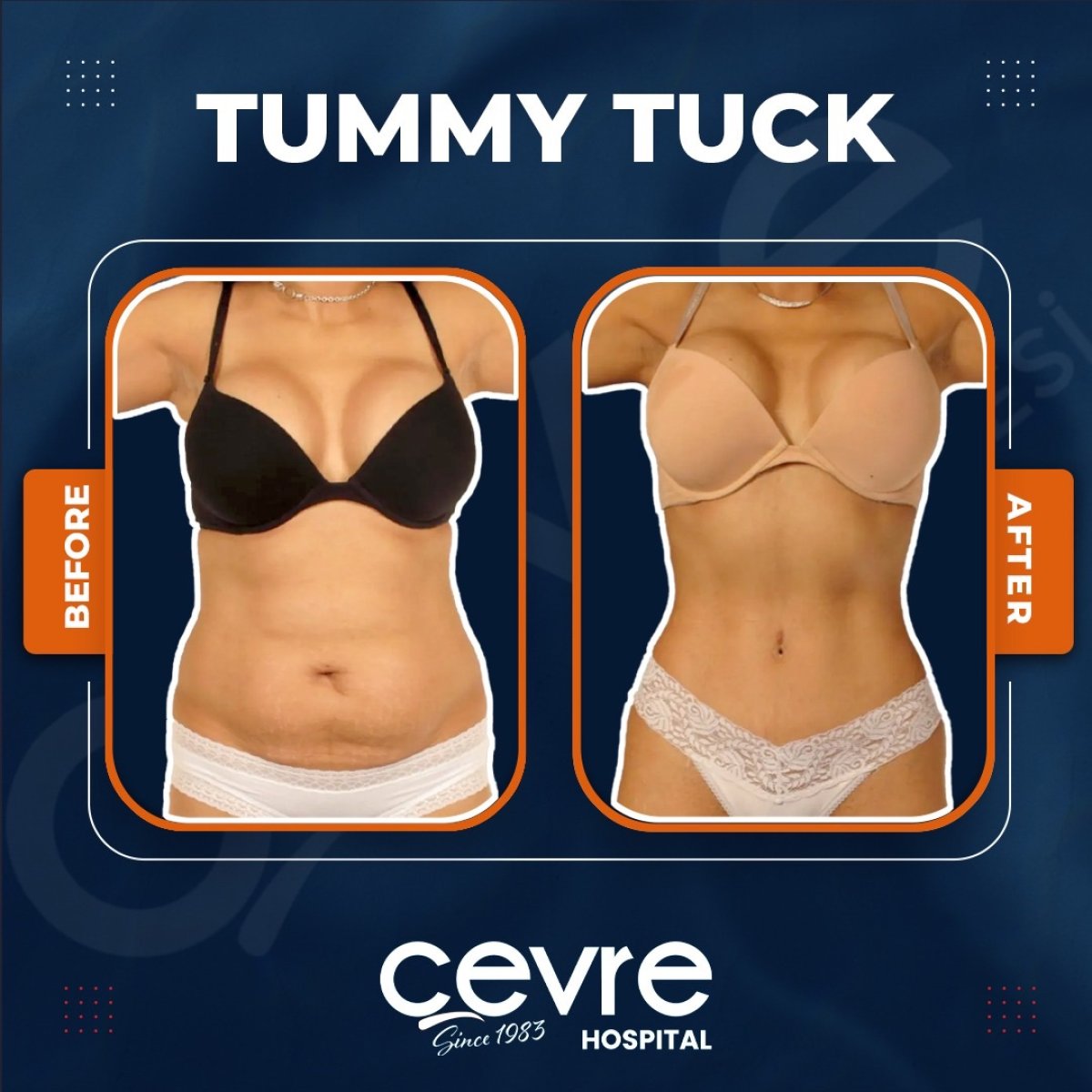 نتائج شفط دهون البطن قبل وبعد في Adem and Havva Medical Center، خصر أنحف