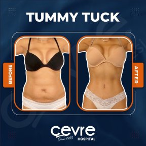 Before and after abdominal liposuction results at Adem and Havva Medical Center, slimmer waist