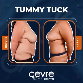 Before and after abdominal liposuction results at Adem and Havva Medical Center, flatter abdomen