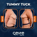 Before and after abdominal liposuction results at Adem and Havva Medical Center, flatter abdomen