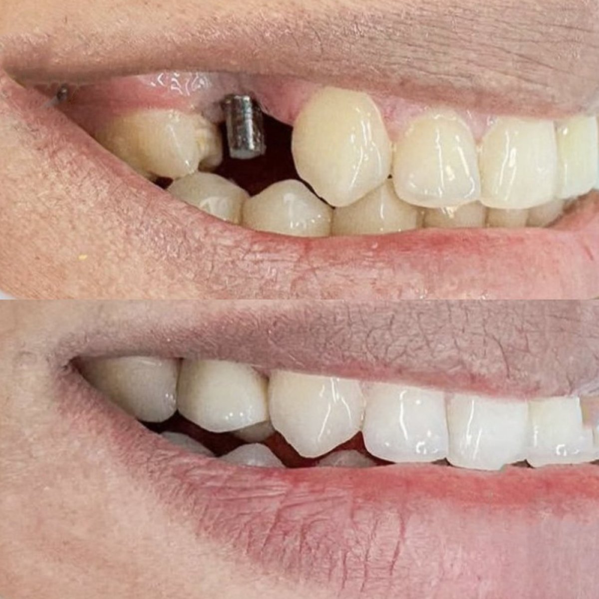 Resultados antes y después de implante dental en Punta Cana dentist odontologia familiar, sonrisa restaurada