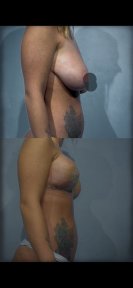 Before and after breast augmentation results at Renaissance Clinic, enhanced breast shape