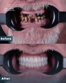Before and after dental implant results at Dentavie Istanbul Dental Clinic, restored smile