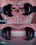 Before and after dental implant results at Dentavie Istanbul Dental Clinic, restored smile