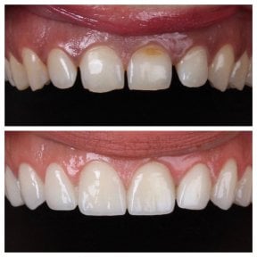 before-after photo zirconia-crown-installation