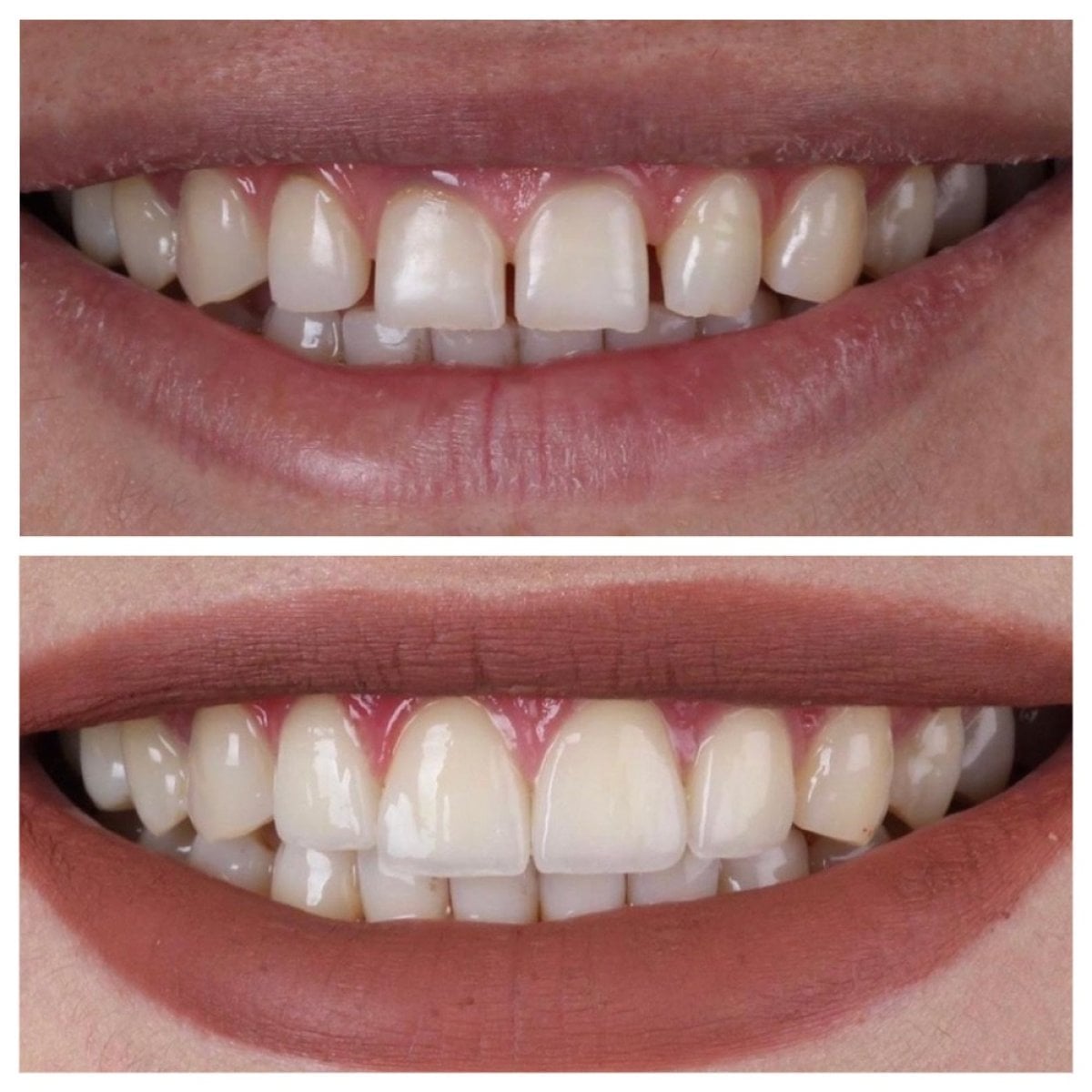 Resultados de antes y después de cambio de sonrisa en Ader Dent Oral and Dental Health Polyclinic