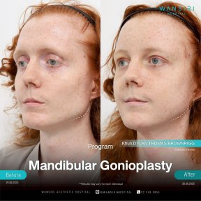 Результати до і після гониопластики щелепи у Wansiri Hospital, покращений контур щелепи