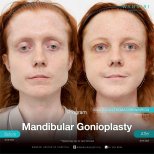 Результати до і після гониопластики щелепи у Wansiri Hospital, покращений контур щелепи