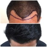 Resultados antes y después de trasplante capilar en Department of Skin & Surgery - NAVAMIN9 HOSPITAL