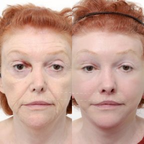 before-after photo lip-lift