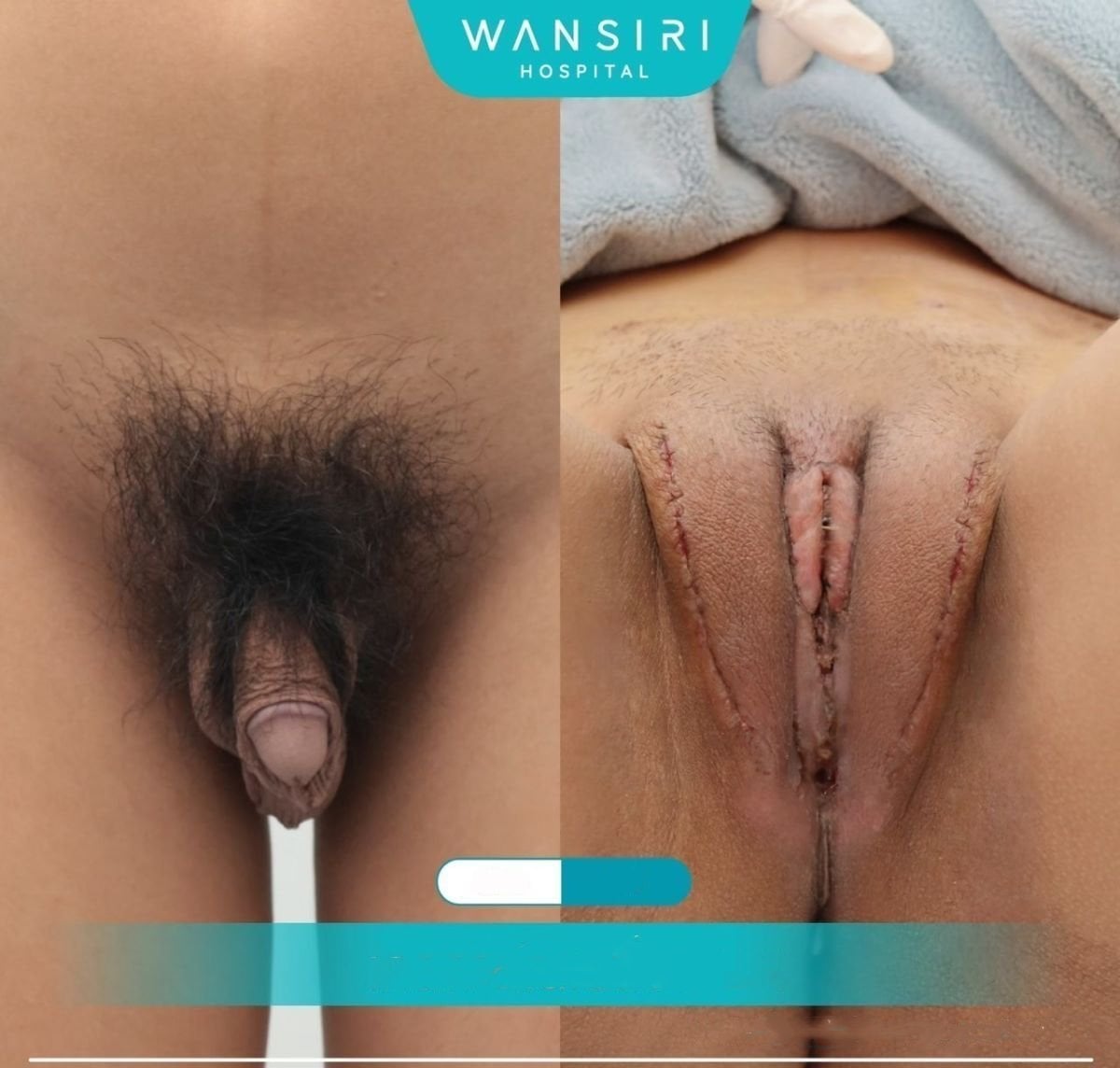 نتائج قبل وبعد عملية تجميل المهبل في مستشفى وانسيري، نتيجة تصحيح الجنس