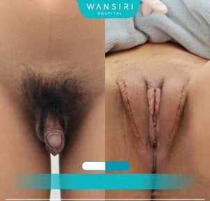 before-after photo vaginoplasty