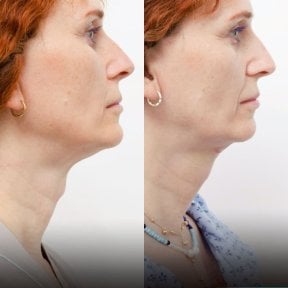 before-after photo adam-s-apple-surgery