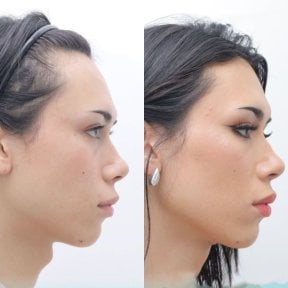 before-after photo adam-s-apple-surgery