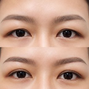 نتائج عملية تجميل الجفون قبل وبعد في مستشفى وانسيري، تحسين شكل الجفون