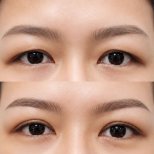 نتائج عملية تجميل الجفون قبل وبعد في مستشفى وانسيري، تحسين شكل الجفون
