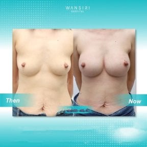 before-after photo breast-augmentation