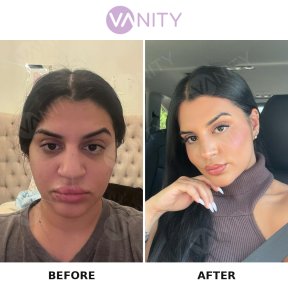 نتائج عملية تجميل الأنف قبل وبعد في Vanity Cosmetic Surgery Hospital، إعادة تشكيل الأنف