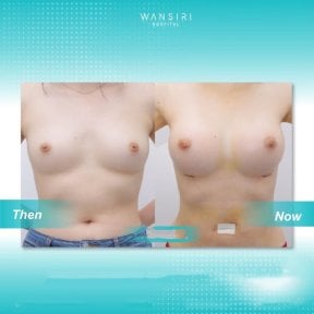 before-after photo breast-augmentation