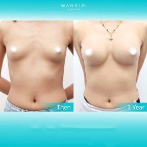 before-after photo breast-augmentation