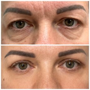 before-after photo blepharoplasty-eyelid