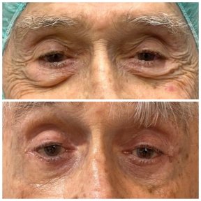 before-after photo blepharoplasty-eyelid